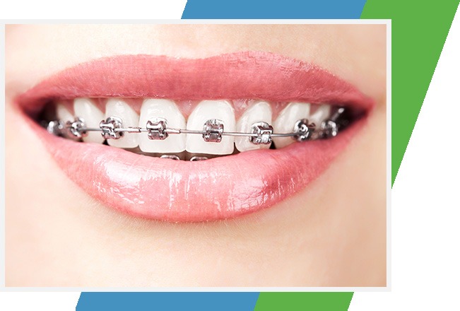 Metal Braces: Should You Go Traditional? « Smile Team Orthodontics