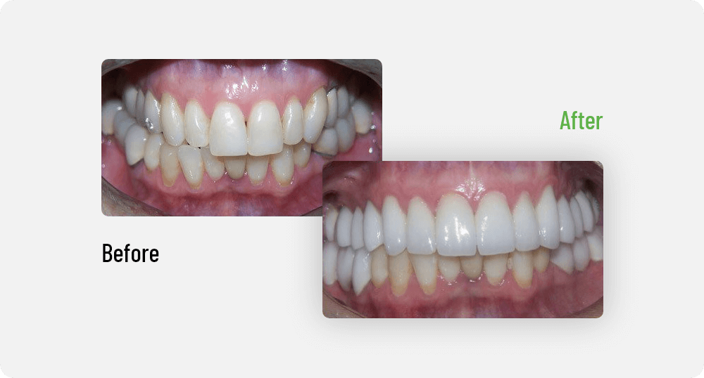 Before & After | Edmonton General Dentist | Sana Dental | Edmonton, AB