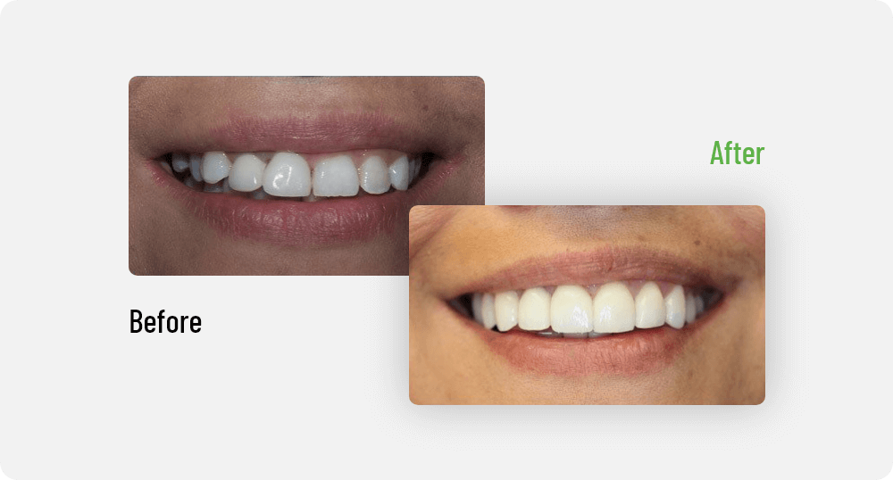 Before & After | Edmonton General Dentist | Sana Dental | Edmonton, AB