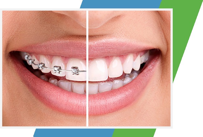 10 FAQs People Have About Dental Adult Braces in Kelowna