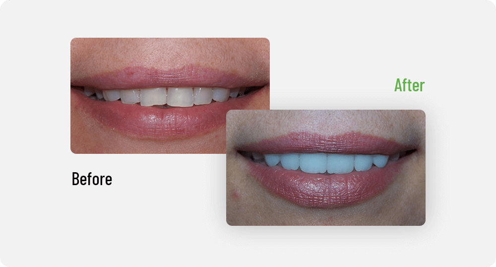 Natalyia Before & After | Edmonton General Dentist | Sana Dental | Edmonton, AB